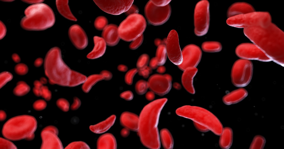 misshapen blood cells